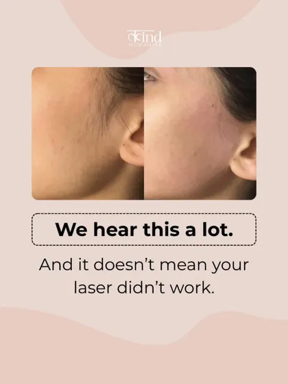 We hear this a lot, but seeing some regrowth does not mean your laser did not work. It is just hair from a different growth cycle. We explain the process at every step so you know what to expect.