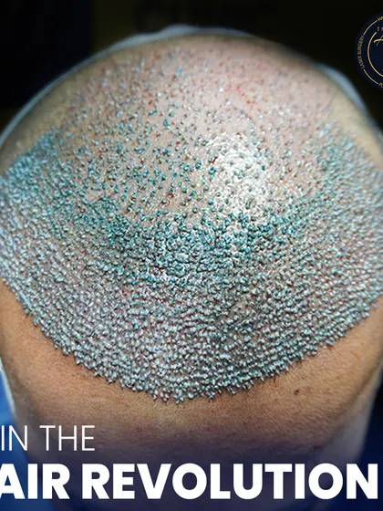 This is where science meets style. A detailed view of newly implanted hair follicles, showcasing the meticulous process of high-density hair restoration.