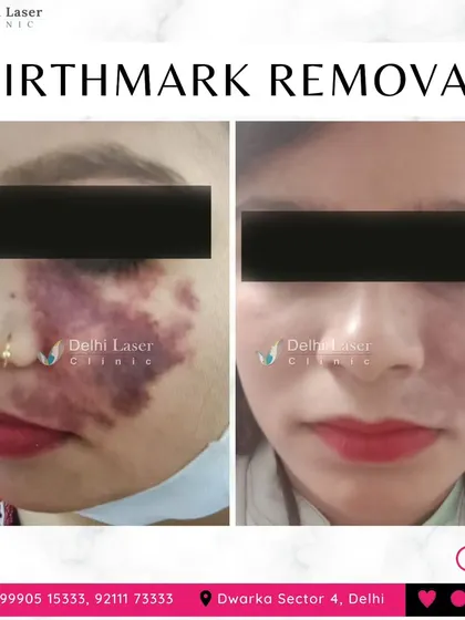 This before and after image shows the significant lightening of a facial birthmark after laser treatment. Our non-invasive laser procedures can effectively reduce the appearance of vascular and pigmented birthmarks with minimal downtime.