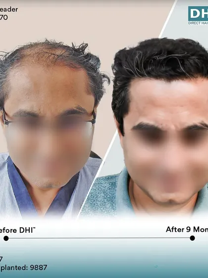 A frontal before and after of the 47-year-old client. The restored hairline and fuller look have given him a renewed sense of confidence just 9 months after his hair transplant.