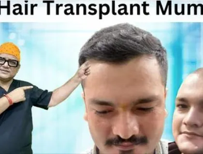 We provide the best hair transplant results right here in Mumbai. This image showcases another happy patient who trusted us with his hair restoration journey and achieved a fantastic outcome.