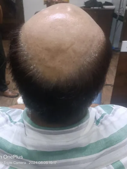 This is the 'before' stage for a client with advanced androgenetic alopecia. The scalp is prepared and ready for the application of a custom non-surgical hair system.