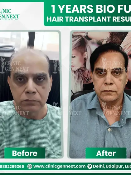 It is never too late to regain your confidence. This 72-year-old patient came to me with advanced hair loss, and with a BIO-FUE procedure, we achieved this natural and dense result in just one year.