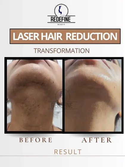 A successful chin laser hair reduction for a female client. This treatment is highly effective for hormonal hair growth, providing a lasting solution and a big boost in confidence.