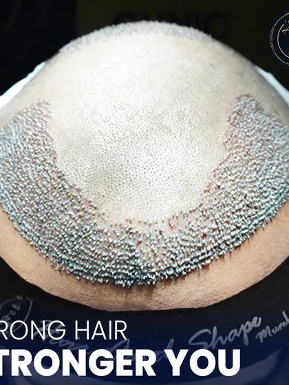 This is where science meets style. A detailed view of newly implanted hair follicles, showcasing the meticulous process of high-density hair restoration.