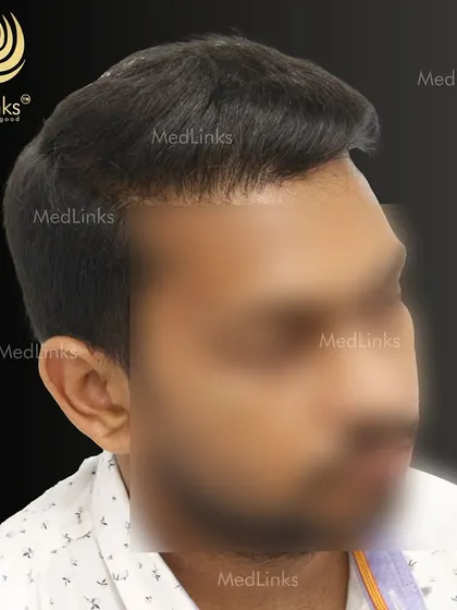 The final result from the side, showing a natural and full head of hair.