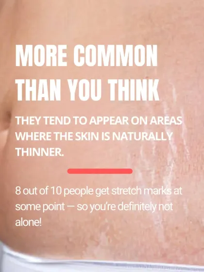 Stretch marks are more common than you think, affecting about 8 out of 10 people at some point in their lives. They often appear on areas where the skin is naturally thinner. You are definitely not alone.