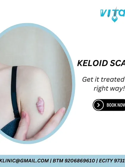 This graphic provides information on keloid scars, which are a form of abnormal scarring. I treat keloids with a multi-modal approach, often combining injections, laser therapy, and surgical removal for the best outcome.