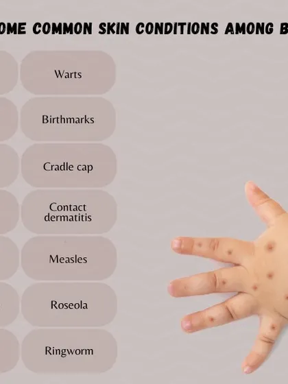 This chart lists some of the many skin conditions that can affect babies, such as hives, diaper rash, eczema, and ringworm. As a pediatric dermatologist, I am trained to diagnose and treat these issues with the utmost care.