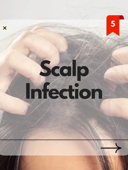 Scalp infections can damage hair follicles and lead to hair loss. It's important to treat any infection promptly to maintain a healthy scalp environment.