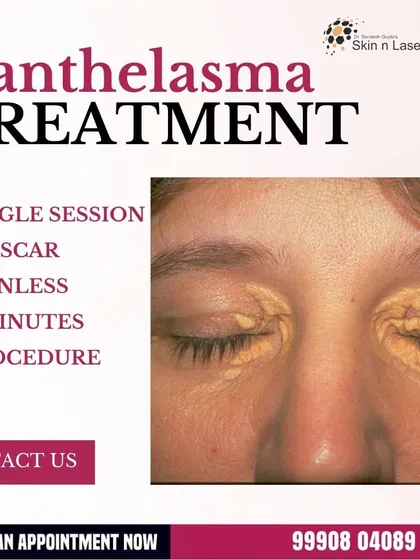 This graphic advertises my Xanthelasma treatment, highlighting that it is a single-session, no-scar, painless, and two-minute procedure. It is a safe and effective way to remove these deposits.