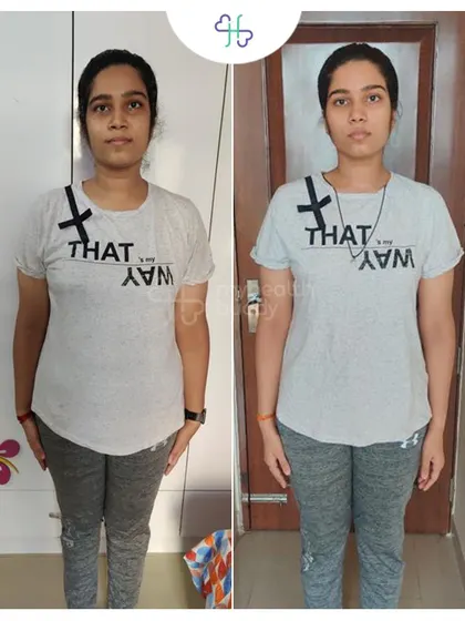 Front view of Torsha's 4kg loss, showing what's possible in a short time with the right guidance.