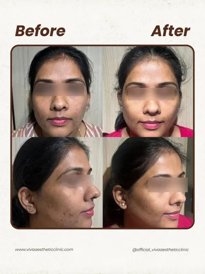 For this patient, we addressed a combination of scattered acne and uneven skin texture. A series of gentle peels and a consistent skincare routine helped smooth her skin and reduce the frequency of breakouts, leading to a clearer and more radiant complexion.