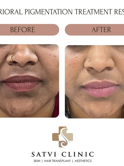This patient was treated for Perioral Melanosis, which is the clinical term for darkening of the skin around the mouth. You can see a visible lightening of the hyperpigmentation and a more even skin tone after a course of dermatologist-guided depigmenting therapy and a strict sun protection regimen.