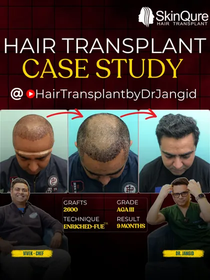 This is a detailed case study of Chef Vivek, who had Grade III hair loss. With 2600 grafts, we restored his hairline and confidence. The 9-month result is a testament to the EnRiched-FUE technique.