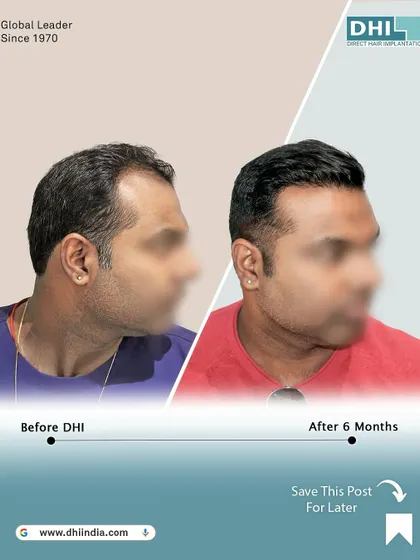 A side-profile view of a 34-year-old client 6 months after receiving 7,159 implanted hairs. The image shows a strong, natural hairline and excellent density, transforming his look.