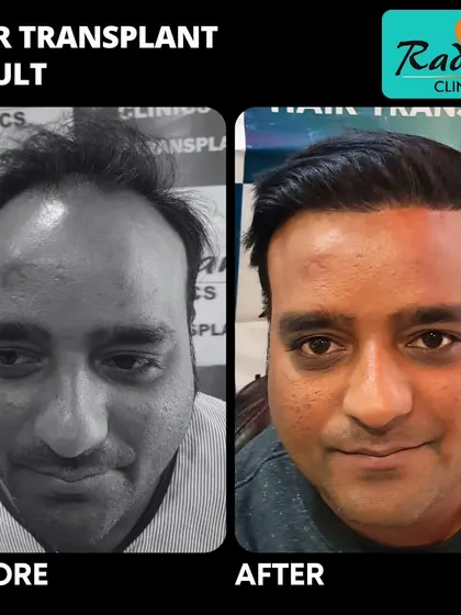 This before-and-after comparison highlights the successful restoration of a patient's hairline and overall density, resulting in a much more youthful and confident look.