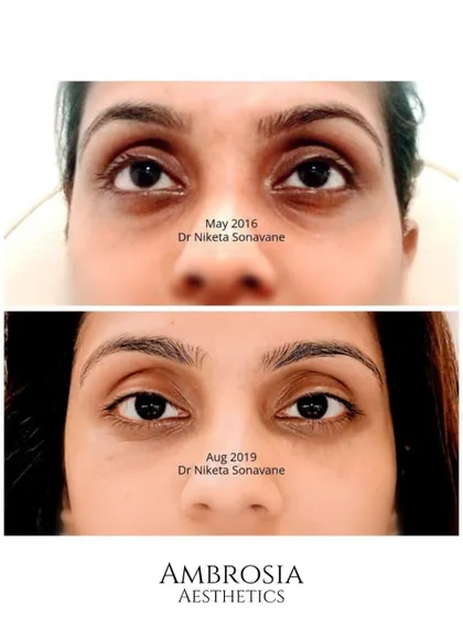 This transformation shows the power of under-eye fillers. By carefully restoring volume to the tear trough area, we can instantly reduce the appearance of hollows and dark circles, making you look more rested and rejuvenated.