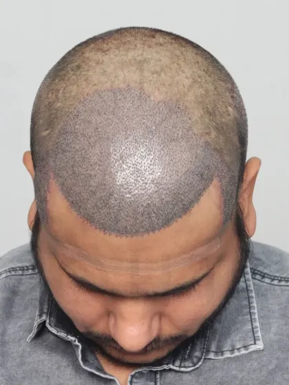 This shows the crucial first step: hairline design. We mark the area precisely to ensure the final result perfectly frames the face.