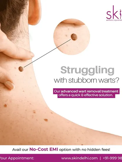 This graphic advertises my advanced wart removal treatment as a quick and effective solution for those struggling with stubborn warts, ensuring clear and smooth skin.