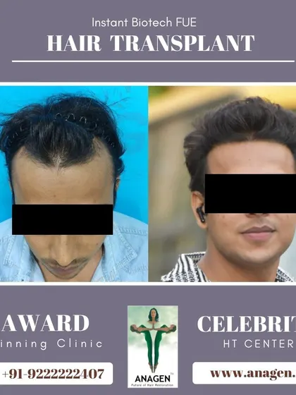 An amazing result from our Instant Biotech FUE hair transplant. The patient's receding hairline is gone, replaced by a full and natural look.