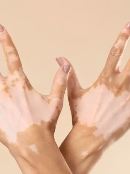 Vitiligo is a condition where the skin loses its pigment cells. I offer comprehensive care, including medical therapies and advanced phototherapy, to help manage the condition, halt its progression, and in many cases, restore lost color.