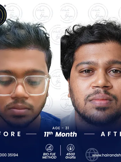 This frontal view at 11 months shows the complete and mature result of a high-graft BIO FUE procedure.