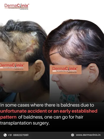 This image shows a successful hair transplant for a patient who experienced baldness due to an unfortunate accident. In such cases, surgery can be a viable option to restore hair and cover scar tissue.