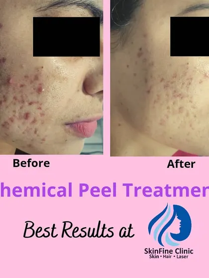 A before and after look at the results of chemical peel treatments for active acne and marks. After just two sessions, you can see a considerable reduction in inflammation and fading of post-acne pigmentation.