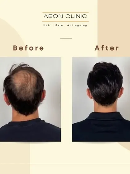 From the back, you can see the dramatic difference our hair transplant has made, turning a thinning crown into a full head of hair.
