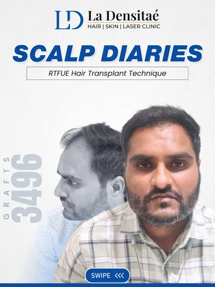 Siddhant just wanted to look like himself again. With 3,496 grafts and the RT-FUE technique, I helped him do just that. The result is simple and honest, a natural look that restored his confidence.