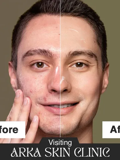 Here is a clear before and after of a male patient who came to me for acne treatment. The result is not just clearer skin, but a visible boost in confidence.