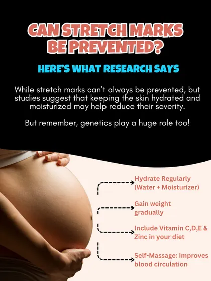 Can stretch marks be prevented? Research suggests that while you can't always stop them, keeping skin hydrated, gaining weight gradually, and good nutrition may help reduce their severity.