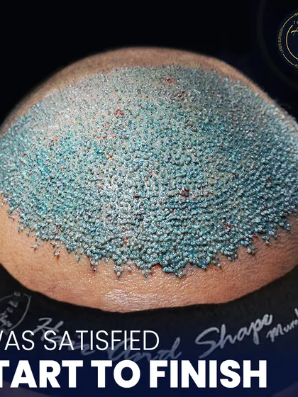 A close-up look at a freshly completed hair transplant. The density and precision in placing each graft are key to achieving a natural, full look.