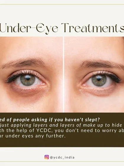 Tired of people asking if you haven't slept? I can help you address tired and dark under-eyes with a range of effective treatments tailored to your specific needs.