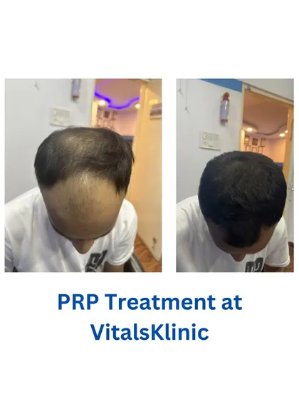 Here is another example of a successful PRP treatment at our clinic. The comparison clearly shows a significant improvement in hair density and scalp coverage, restoring a fuller look for the patient.