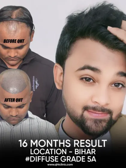 A complete transformation for our patient from Bihar. In 16 months, we addressed his Grade 5A diffuse thinning with 4400 grafts, restoring his hairline, mid-scalp, and most importantly, his smile.