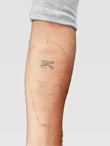 Before: This client had a small, faded initial tattoo surrounded by scar tissue on their forearm.
