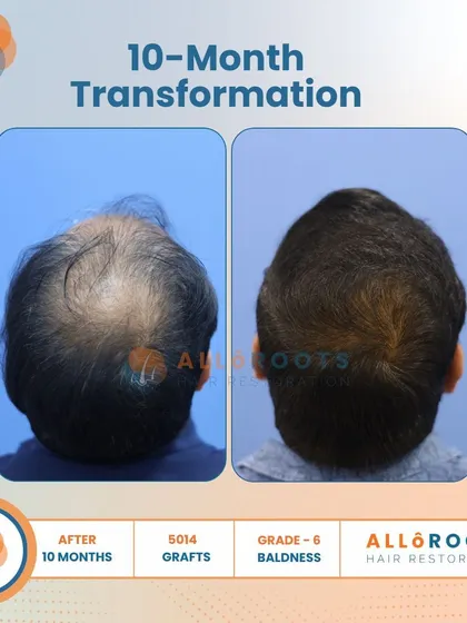 This 10-month transformation is a powerful example of tackling advanced Grade 6 baldness. With 5014 grafts, we achieved remarkable coverage and density, as seen from all angles.