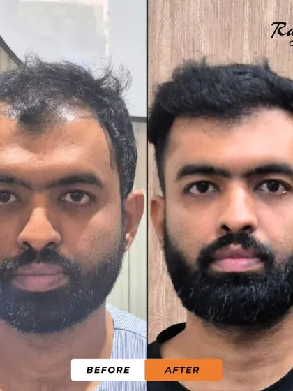 A frontal before-and-after of the patient from video 17. The change is dramatic, restoring his hairline and giving him a more youthful and confident appearance.