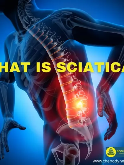This image introduces sciatica, a common cause of radiating leg pain that I treat.