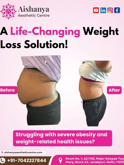 This before-and-after image shows a real patient's result from a body contouring procedure. For those struggling with stubborn fat or obesity-related issues, this can be a life-changing solution to achieve a healthier shape.