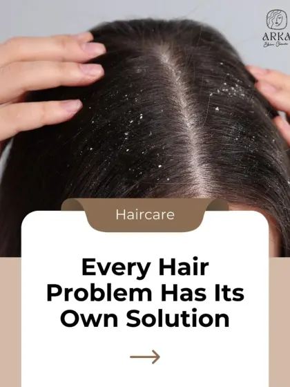 This image shows a common problem: dandruff. But not all dandruff is the same. I help you find the right solution for your specific scalp issue.