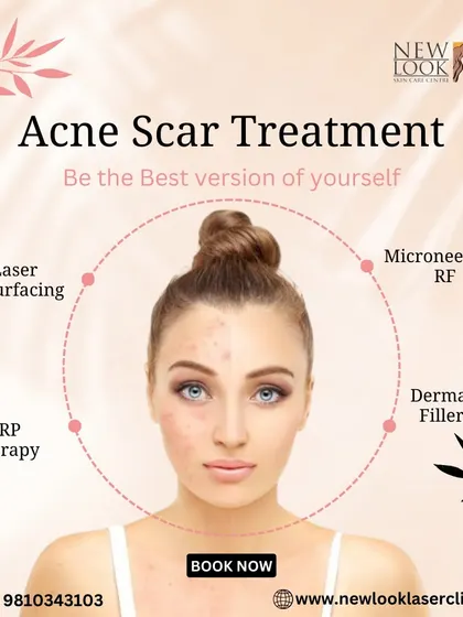 We offer a comprehensive range of solutions for acne scars, because no two skin types are the same. This visual outlines some of our most effective approaches, including Laser Resurfacing, Microneedling RF, PRP Therapy, and Dermal Fillers, all tailored to your specific needs after a thorough skin analysis.