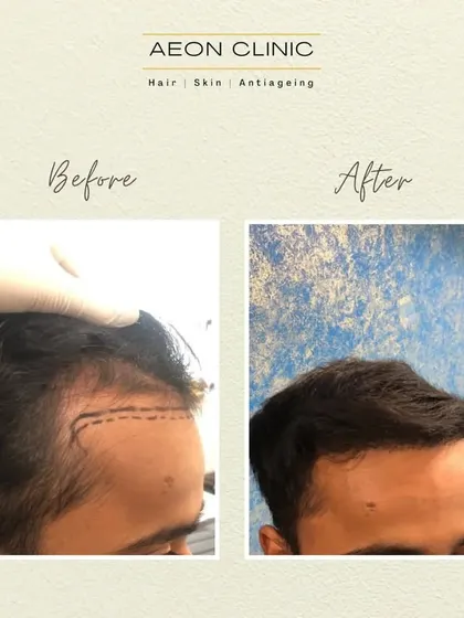 A close-up of a hairline transformation. The 'after' photo shows a dense, well-defined hairline that perfectly frames the face.