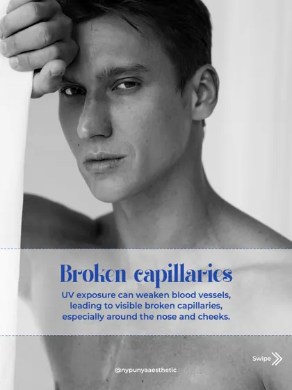 UV exposure can also weaken blood vessels, leading to broken capillaries that become visible around the nose and cheeks.