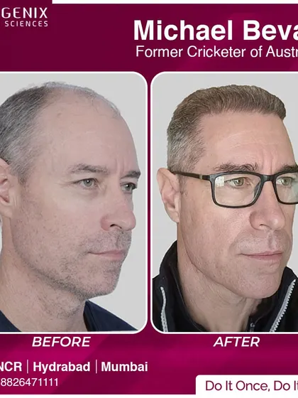 The before and after transformation of former Australian cricketer Michael Bevan, showcasing our global appeal among sports icons.