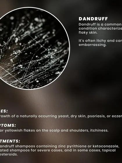 Dandruff is a common scalp condition characterized by itchy, flaky skin. It can be caused by yeast overgrowth or dry skin, and is treatable with medicated shampoos containing ingredients like zinc pyrithione.