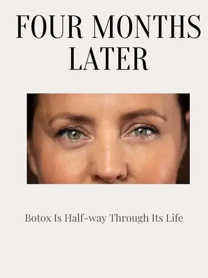 Four months after treatment, Botox is about halfway through its life. You may start to notice a gradual return of muscle movement, but the effects are still strong, keeping wrinkles at bay.