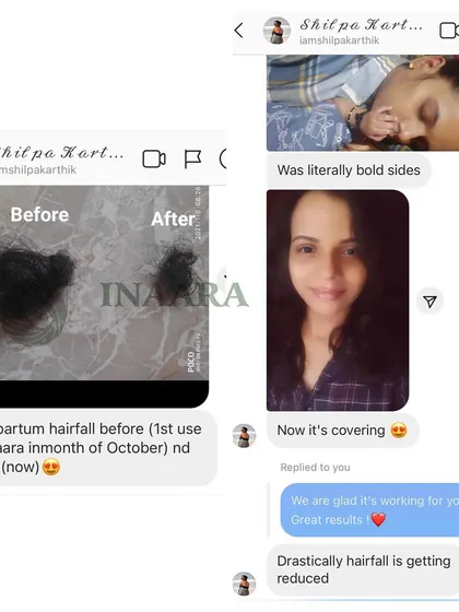 Here is another look at the reality of postpartum hair fall and the recovery possible with the right care. The image on the left shows the amount of hair fall she experienced, which was drastically reduced after using my products.